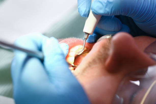 Best Emergency Wisdom Teeth Removal in Elk City, OK