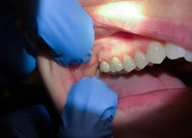 Best Emergency Wisdom Teeth Removal in Elk City, OK